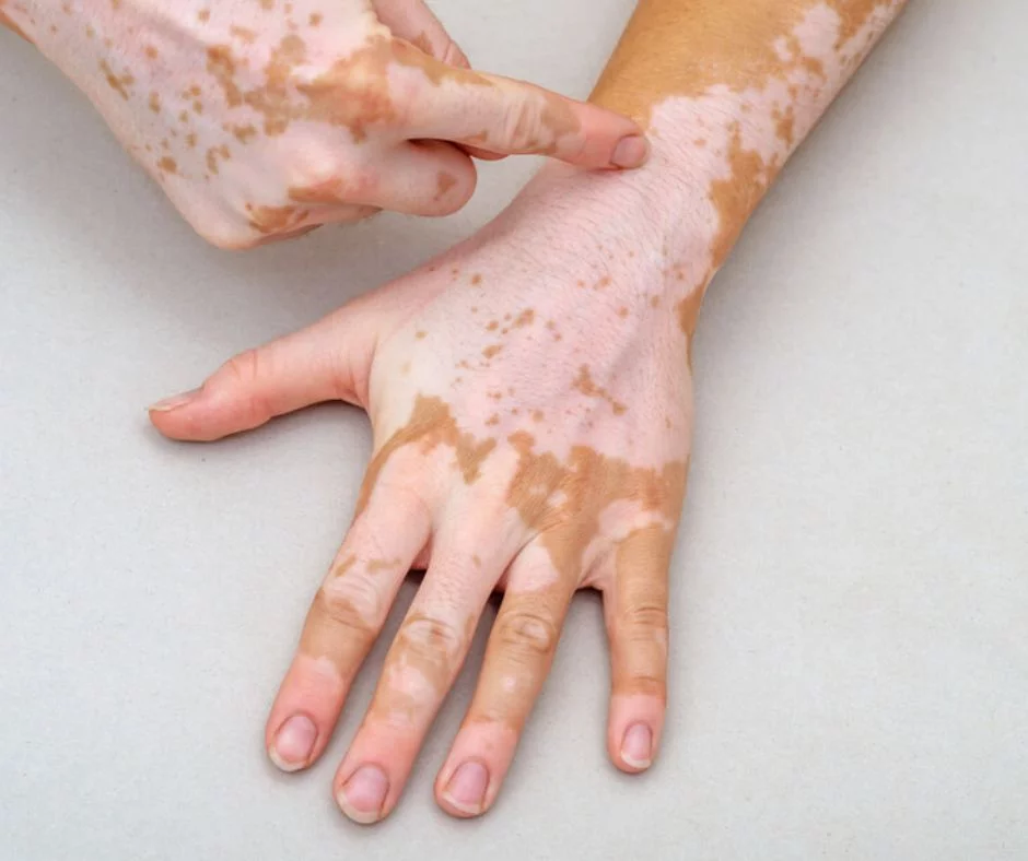Descubra As Origens Das Manchas Brancas Na Pele: 8 Causas Comuns Que Você Precisa Conhecer! 7 Manchas brancas na pele vitiligo