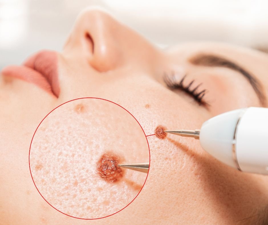Desvende Os Segredos Das Manchas Na Pele: 6 Tipos Diferentes Para Você Cuidar! 11 Manchas na Pele Melanoma