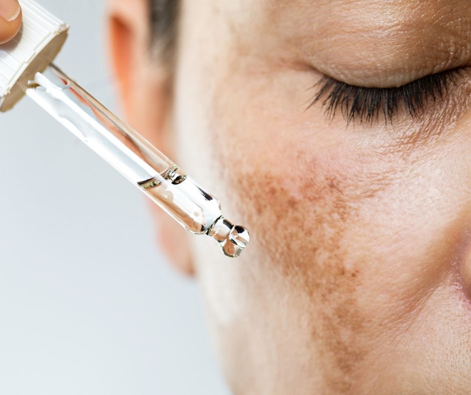 Desvende Os Segredos Das Manchas Na Pele: 6 Tipos Diferentes Para Você Cuidar! 6 Manchas na Pele Melasma